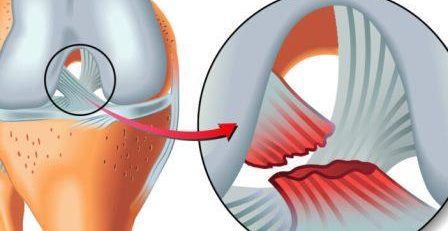 Rotura del ligamento cruzado anterior LCA