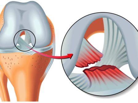 Rotura del ligamento cruzado anterior LCA
