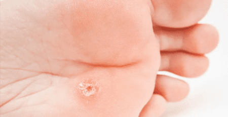 El tratamiento de un papiloma en el pie por tu podólogo