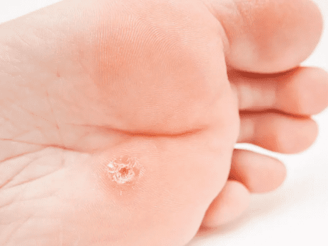El tratamiento de un papiloma en el pie por tu podólogo