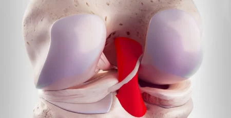 Rotura del ligamento cruzado posterior (LCP): ¿Cómo rehabilitarlo?