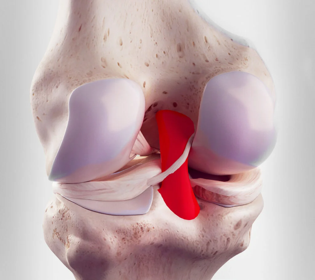 Rotura del ligamento cruzado posterior (LCP): ¿Cómo rehabilitarlo?