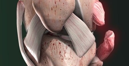 Lesiones del ligamento colateral medial: ¿cuándo puedo volver a hacer deporte?