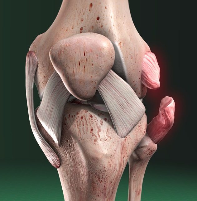 Lesiones del ligamento colateral medial: ¿cuándo puedo volver a hacer deporte?