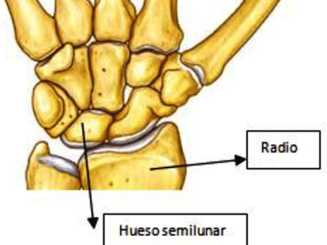 Lesión del hueso semilunar ¿cómo inmovilizarlo?
