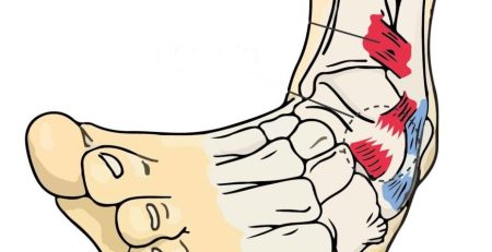 Me he torcido el tobillo ¿cómo saber si es un esguince o una fractura?