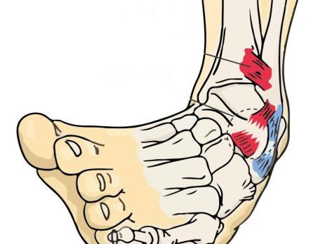 Me he torcido el tobillo ¿cómo saber si es un esguince o una fractura?
